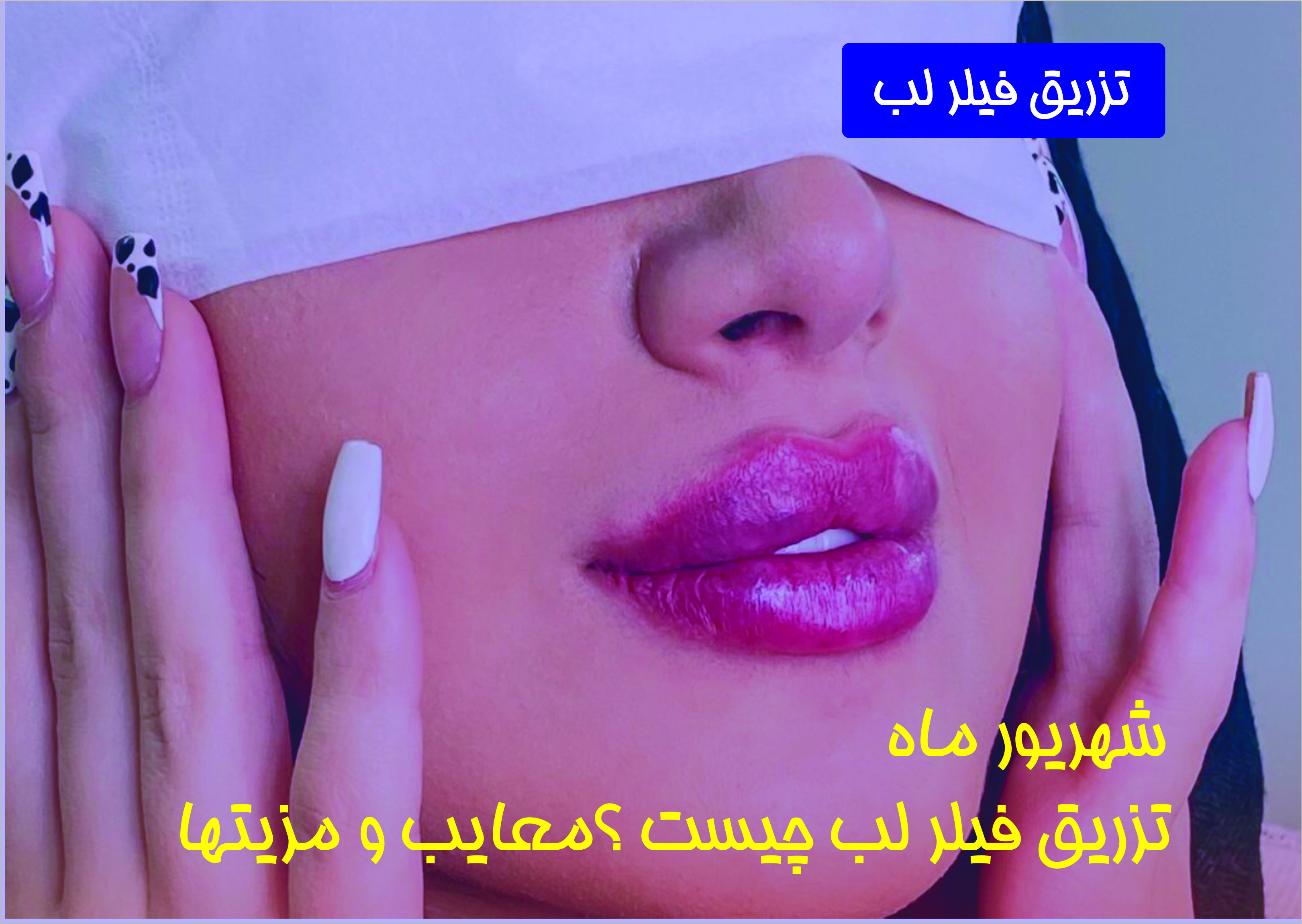 تزریق ژل و بوتاکس در شمال تهران