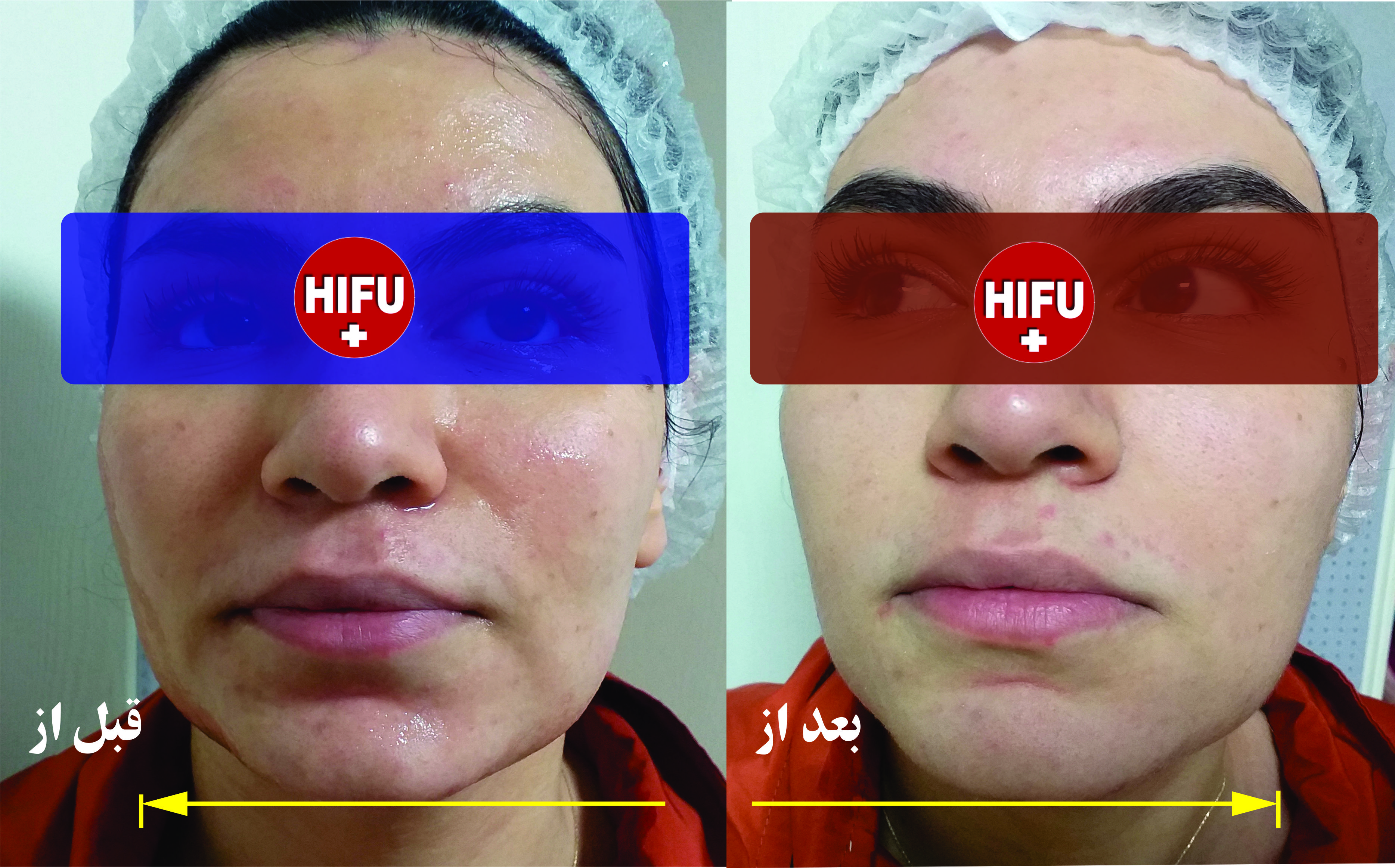 بهترین و مجهزترین مرکز هایفوتراپی در غرب تهران