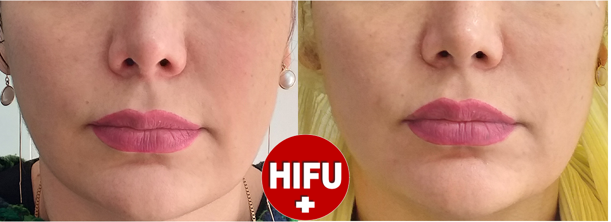 هایفوتراپی غرب تهران