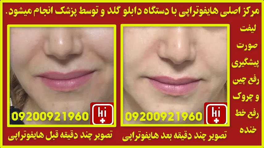 هزینه هایفوتراپی صورت