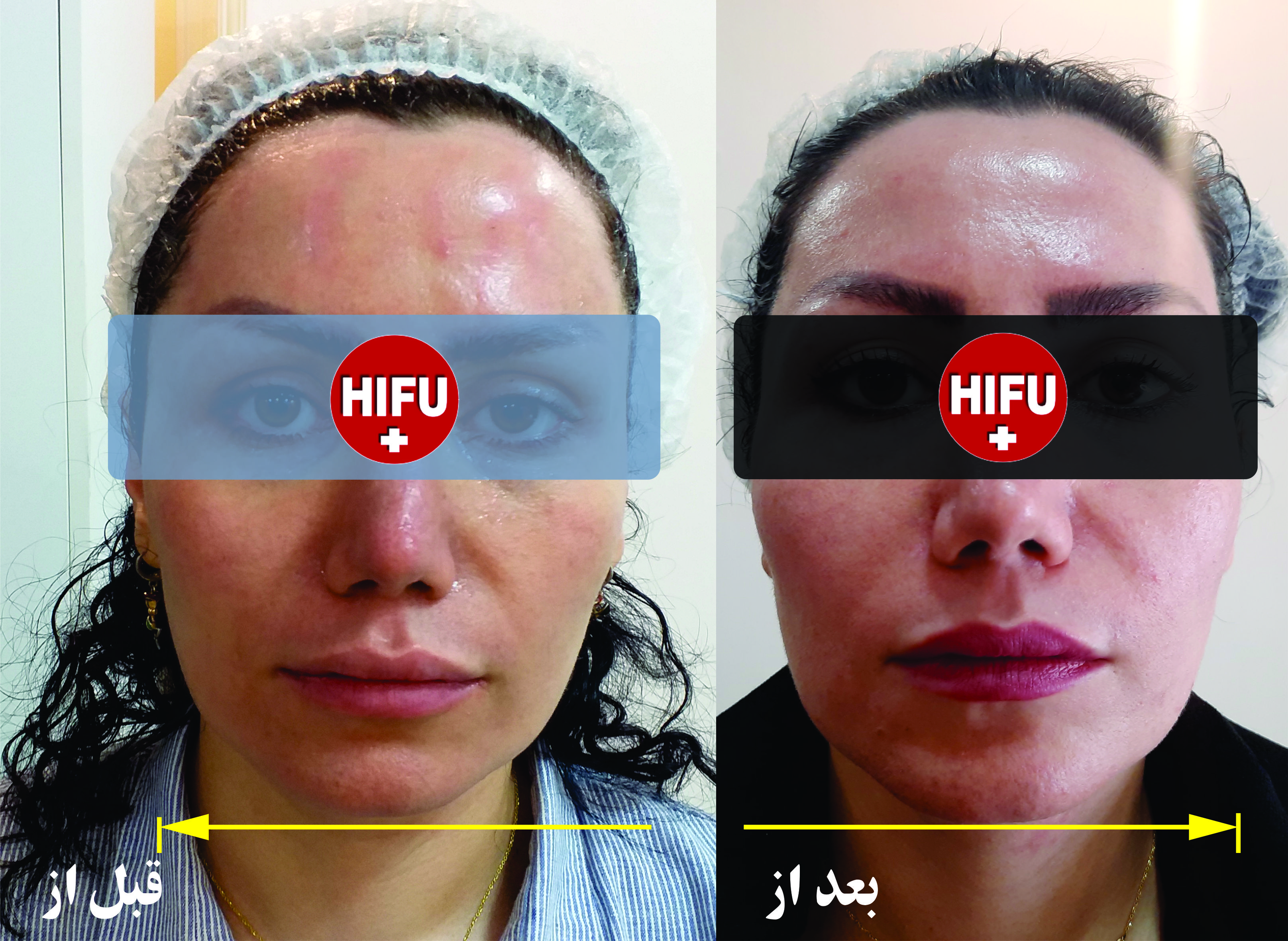 هایفوتراپی بهترین .هزینه .بهترین پزشک