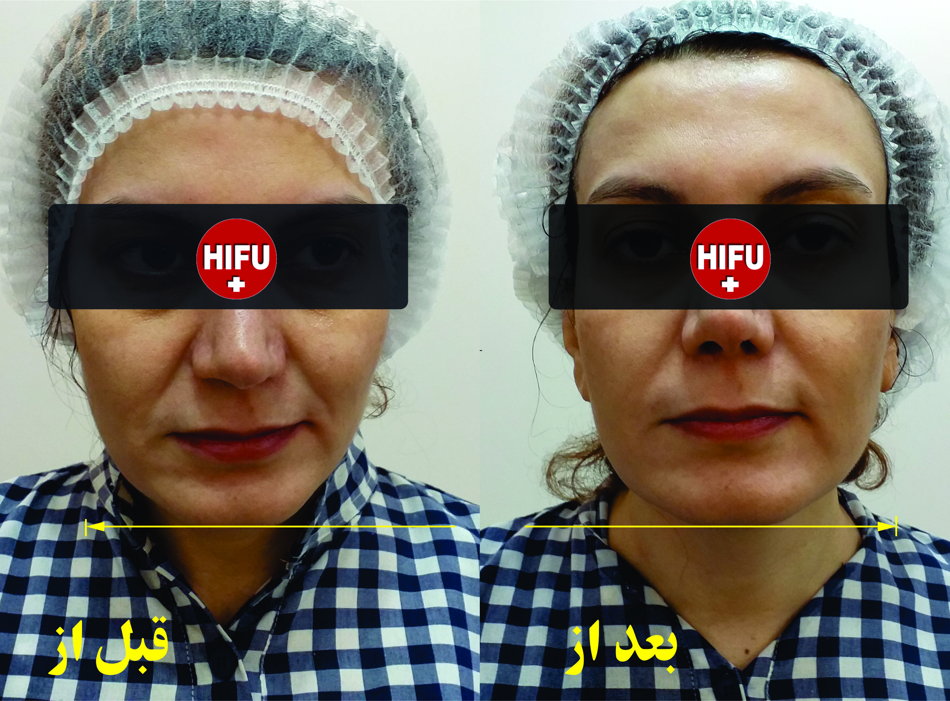 بهترین مرکز هایفوتراپی .هزینه .بهترین دکتر